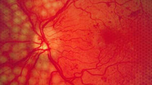 Diabetic macular edema risk seen with thiazolidinediones Thumbnail