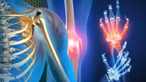 Lipid lowering effective in inflammatory joint disease Thumbnail