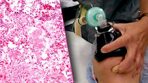 Gram stain not accurate for assessing ventilator-associated pneumonia Thumbnail