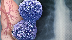Gefitinib may be superior to pemetrexed as second-line treatment for lung cancer Thumbnail