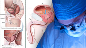 Pelvic plexus block effective for prostate biopsy-related pain Thumbnail
