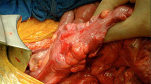 Detection of serrated colorectal lesions challenging on colonoscopy Thumbnail