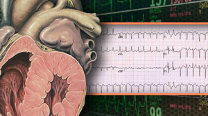 Hybrid surgery/catheter AF ablation feasible and safe Thumbnail