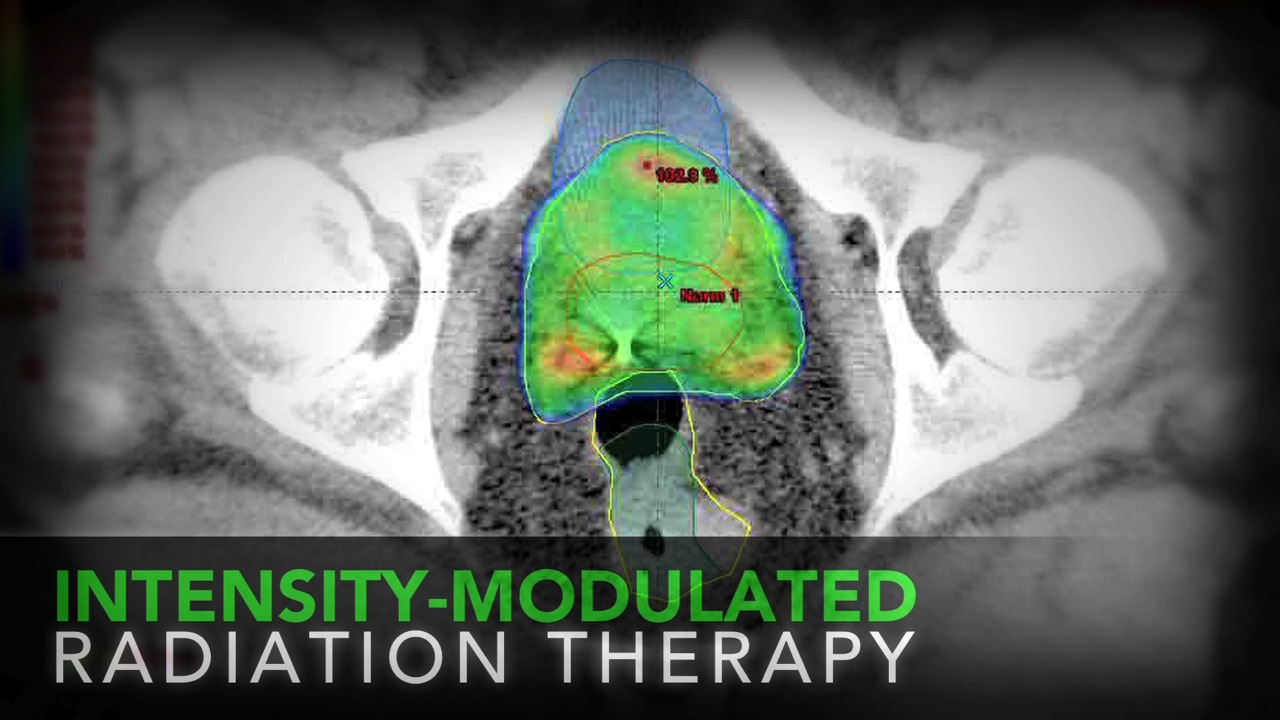 New Radiation Therapy Technology for Prostate Cancer Treatment Thumbnail