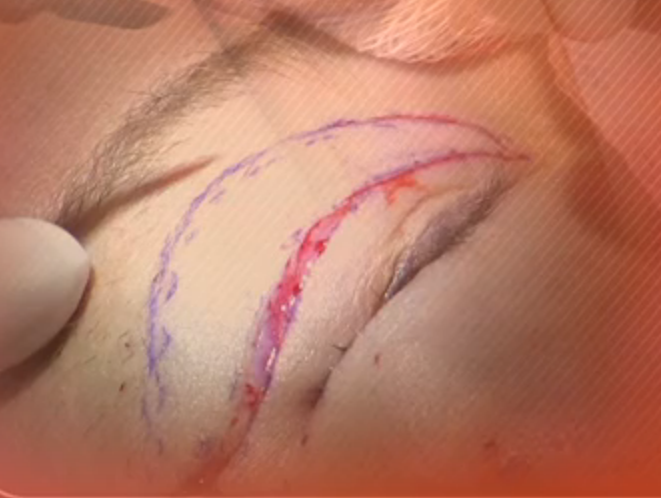 New Trends In Plastic Surgery Thumbnail