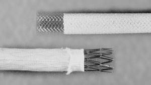 Advantages of metallic ureteral stent questioned in malignant obstruction Thumbnail