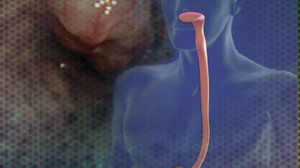 Is minimally invasive esophagectomy for cancer as good as open? Thumbnail