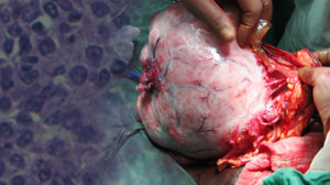 No gain from extensive lymphadenectomy in 2nd-look surgery for ovarian CA Thumbnail