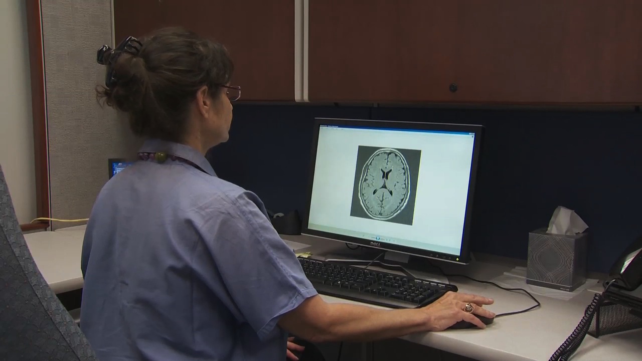 Migraine Headaches Associated With Higher Incidence of Brain Lesions in Women Thumbnail