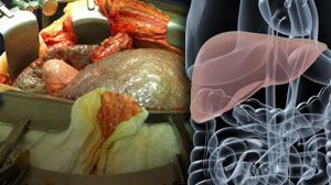 Sirolimus Advantageous After Liver Transplantation for Cancer Thumbnail