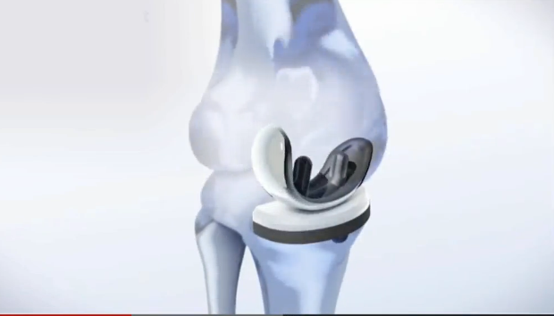 Stem Cell Therapy May Revolutionize Knee Replacements Thumbnail