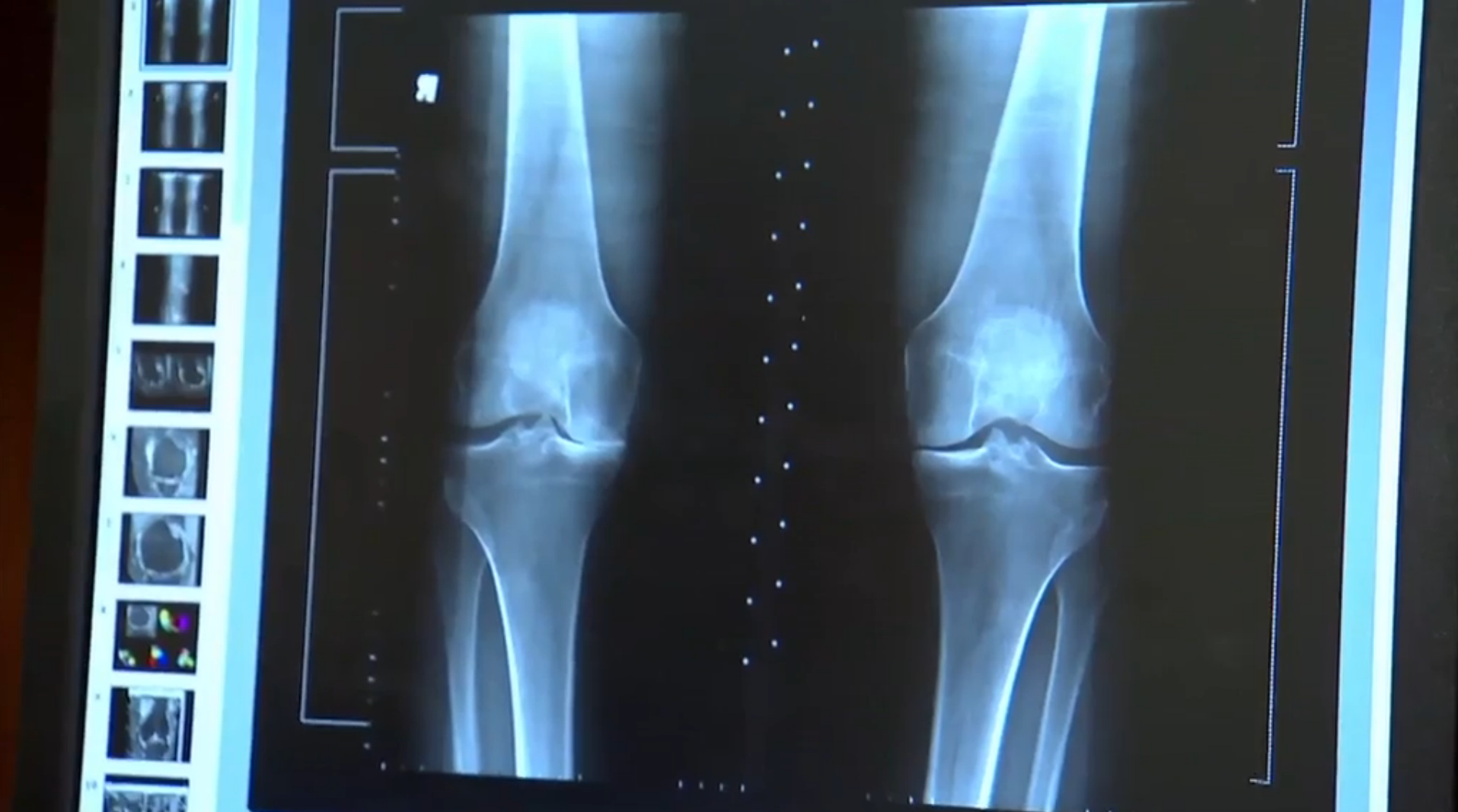 Vitamin D Shows No Major Effect on Pain or Slowing Progression of Knee Osteoarthritis Thumbnail