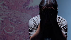 Toremifene Does Not Cut Progression of Prostatic Intraepithelial Neoplasia Thumbnail