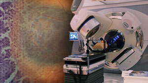 Intensive Surveillance for Choroidal Melanoma Metastasis Raises Secondary Cancer Risk Thumbnail