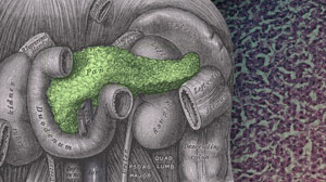 TNF Gene Transfer Safe but Ineffective Against Pancreatic Cancer Thumbnail