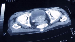 Dutasteride May Suppress Prostate Cancer Development Temporarily Thumbnail