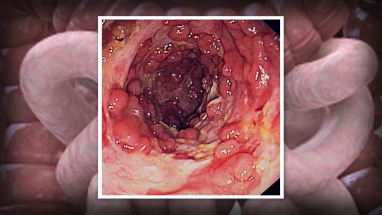 Can Eating Worms Treat Autoimmune Disorders? Thumbnail