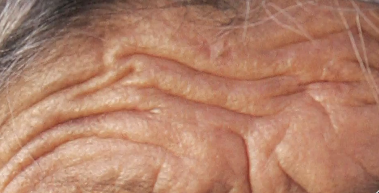 Winning The War Against Wrinkles Thumbnail