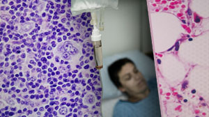 Alkylating Agents for Hodgkin Lymphoma Tied to Risk of Secondary Leukemia Thumbnail