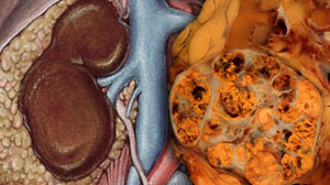 Cardiovascular Toxicity Risk High with Targeted Therapies for Advanced Kidney Cancer Thumbnail