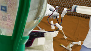Autologous Stem-cell Transplant Improves Outcome of Transformed Follicular Lymphoma Thumbnail