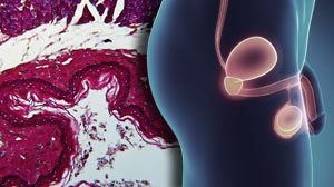 Anticoagulants Tied to Better Survival in Metastatic Castration-resistant Prostate Cancer Thumbnail