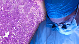 Incidental Thyroid Cancer Rate High After Thyroidectomy Thumbnail