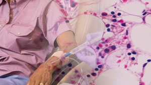 Stem-cell Transplant for AML May Be Best Delayed Until Relapse Thumbnail