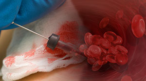 Most Central Venous Catheter Complications Manageable Without Removal Thumbnail