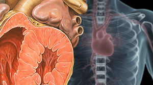 Cardiovascular Side Effects of Bevacizumab Modest in Elderly CRC Patients Thumbnail