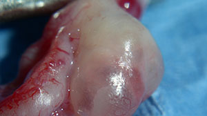Intraperitoneal Chemo for Ovarian Cancer Improves Long-term Survival Thumbnail