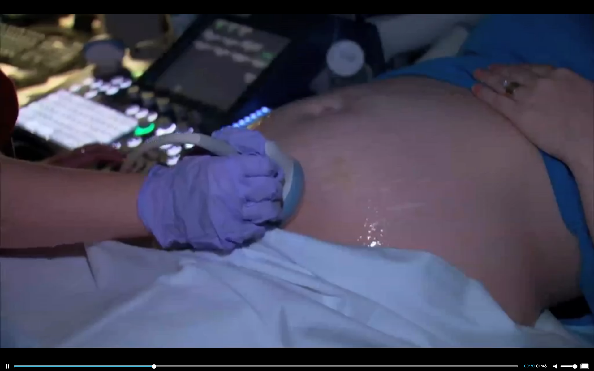 Antiepileptic Drug Taken by Pregnant Women Associated with Increased Risk of Autism in Children Thumbnail