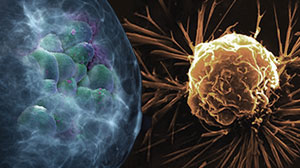 Lapatinib Aids Paclitaxel in Metastatic Breast Cancer Thumbnail