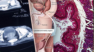 Value of PCA3 Testing Still Unclear in Prostate Cancer Decision-Making Thumbnail