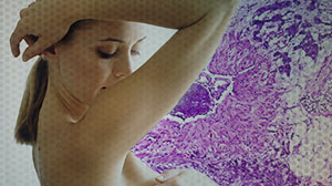 Trastuzumab Effective in HER2-Positive Invasive Lobular Breast Cancer Thumbnail
