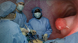 Outcomes Reassuring for Laparoscopic Rectal Cancer Surgery Thumbnail