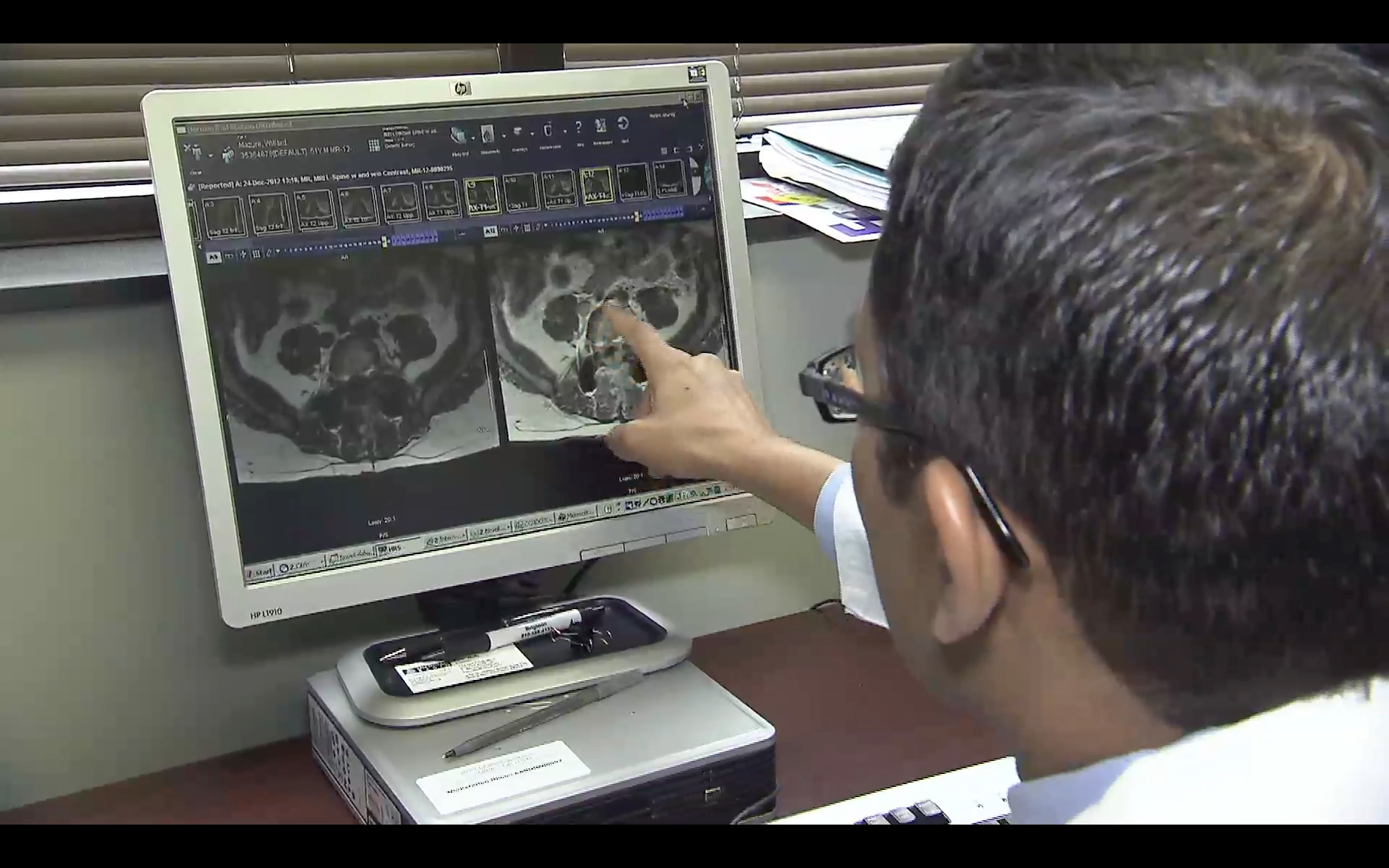 MRI Detects Spinal Infection in Patients Who Received Contaminated Steroid Injections but Reported No New Symptoms Thumbnail
