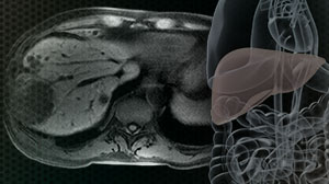 Tumor Ablation Effective for Bilateral Colorectal Liver Metastases Thumbnail