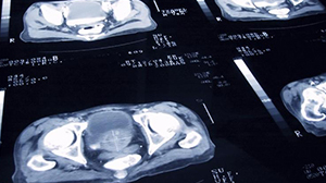 Radical Prostatectomy Improves Survival in Lymph Node-Positive Prostate Cancer Thumbnail