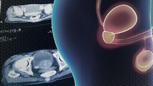 Laparoscopic Prostatectomy Linked to Increased Risk of Incisional Hernia Thumbnail