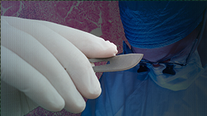 Complication Rate Reasonable with Inguinal Lymphadenectomy for Penile Cancer Thumbnail