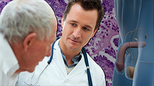 High-Risk Prostate Cancer Responds Well to Radiotherapy Plus Androgen Deprivation Thumbnail