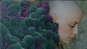 Jaw Osteonecrosis Risk Low with Adjuvant Zoledronate for Breast Cancer Thumbnail