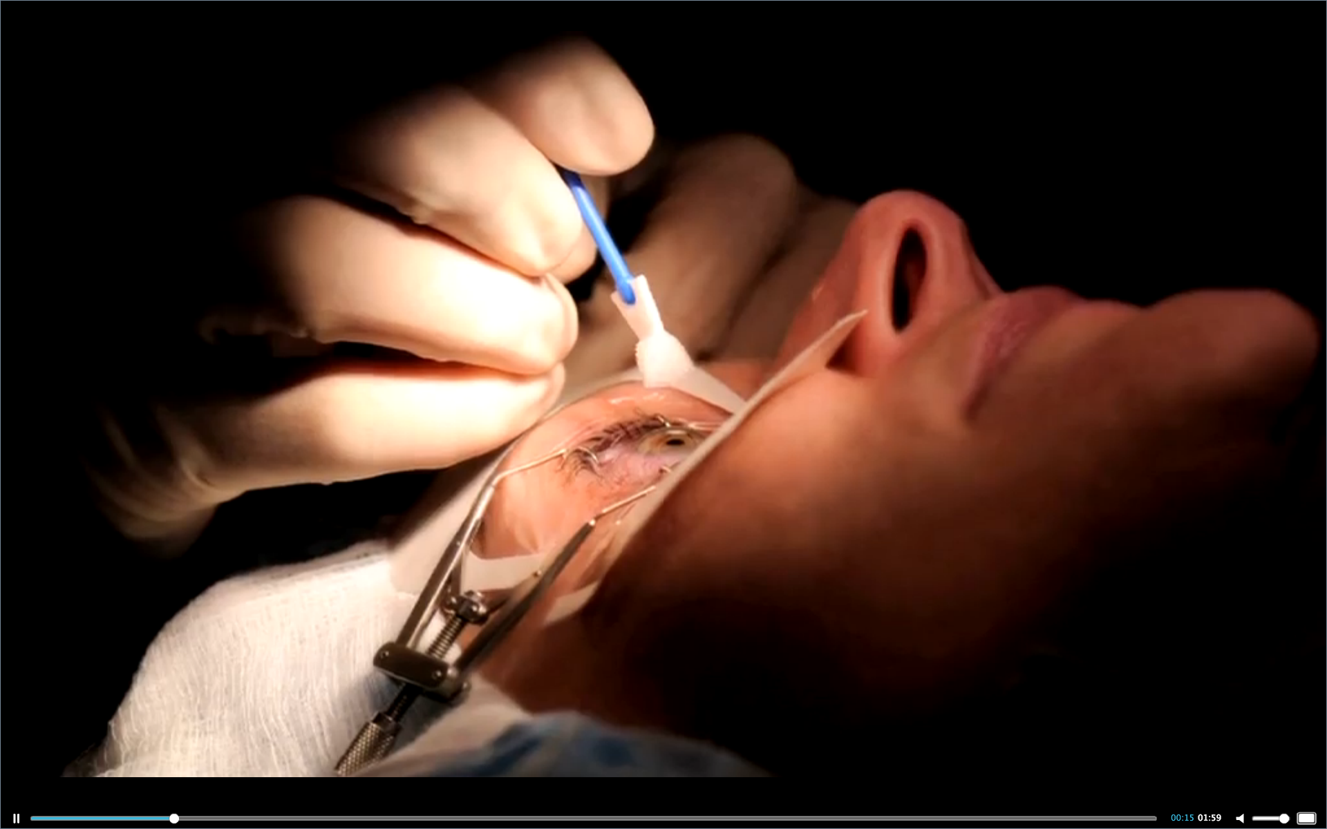 A Cure for AMD? The Future of Care Thumbnail