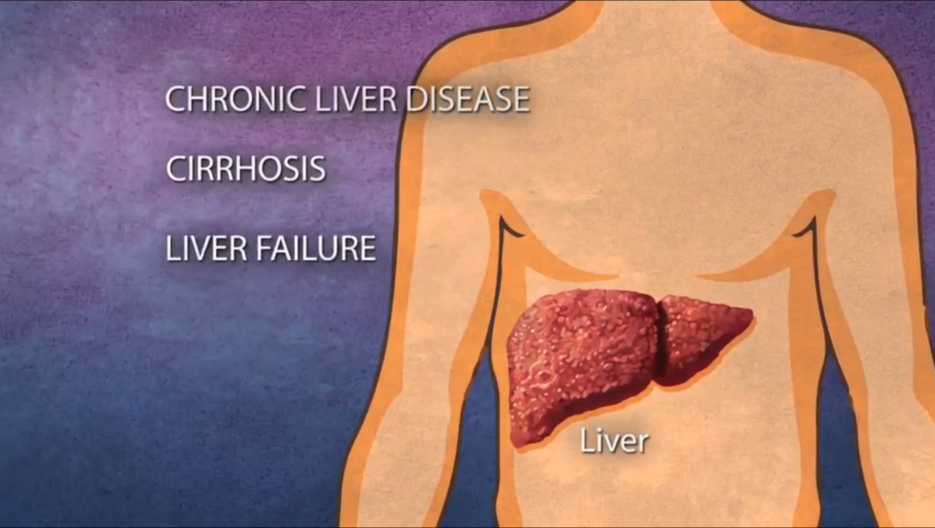Viral Levels Reduced in Patients with Chronic Hep C Infections Treated with Interferon-Free Regimen Thumbnail