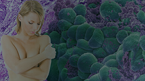 Tamoxifen Does Not Lower HRT-Related Breast Cancer Risk Thumbnail