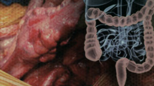 Primary Location Affects Efficacy of Bevacizumab for Metastatic Colorectal Cancer Thumbnail