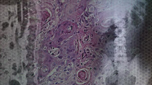 Carbon Ion Radiotherapy Improves Primary Spinal Sarcoma Thumbnail