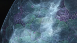 Adjuvant Bevacizumab No Benefit in Triple-Negative Breast Cancer Thumbnail