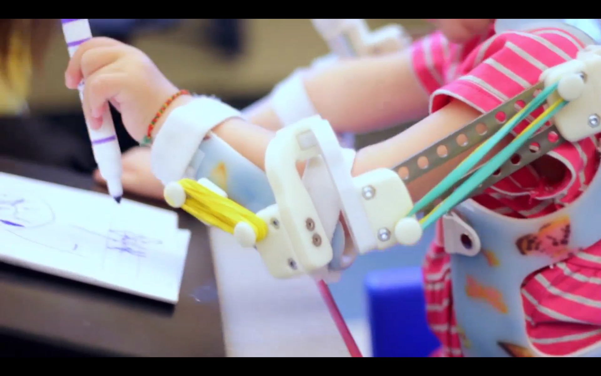 3D-Printed ‘Magic Arms’ Give Hope for Girl with Rare Congenital Disease Thumbnail